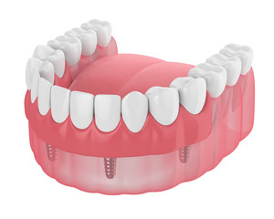 3d render of implant partial denture