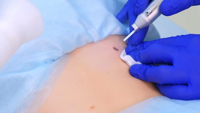Doctor surgeon operation removes mole using laser on patient back, closeup view. One day surgery concept. Removing birthmark making surgical procedure by burning with laser beam. Cosmetic treatment.