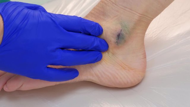 Surgeon palpates leg around suture after surgery to remove ankle hygroma, hand closeup. Recovery, rehabilitation, therapy and treatment after surgery. Wound healing with stitches.