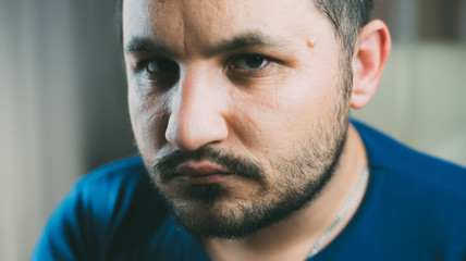 The tumor on the face of men near his temple , Lipoma Wen or zit, ugly acne, dermatology and ugliness