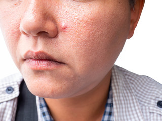 Closeup of red skin with acnes