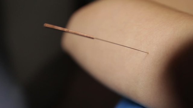 Acupuncture.Dry needling.A close-up of a needle sticking into a patient's forearm.Trigger point therapy.Traditional Chinese medicine