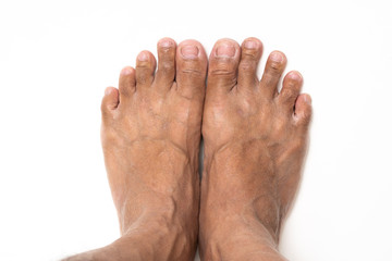 Asian man foot brown and dry skin