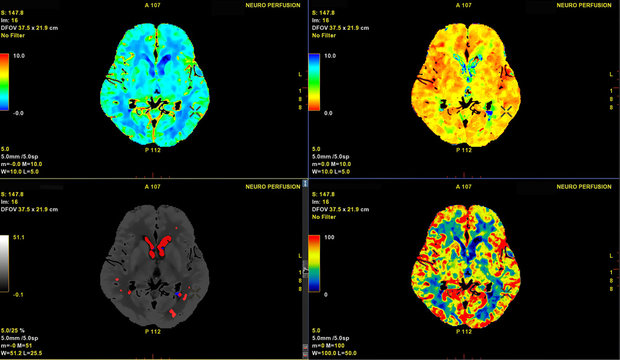 CT Brain Perfusion or CT scan image of the brain 3d rendering image analysing cerebral blood flow on the monitor.
