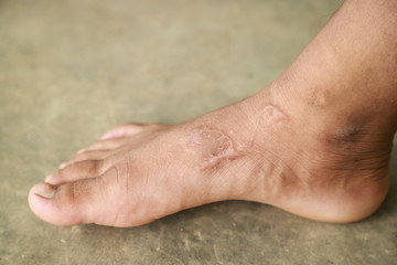 old scar on human skin 