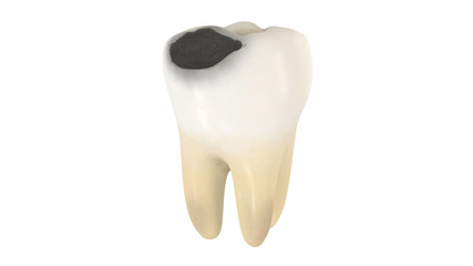 3D illustration of a tooth decay