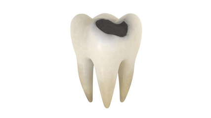 3D illustration of a tooth decay