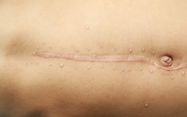 old scar wound from operation in medical 