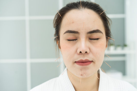  Asian Woman face undergoing acupuncture treatment or Needle Therapy at the health spa or hospital, copy space for text advertine or product your. Traditional Chinese Medicine Concept