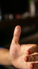 An infection wound with pus inside the thumb.