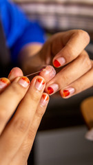 Naklejka premium Removing pus in the wound infection from the thumb. Infected, fingers.