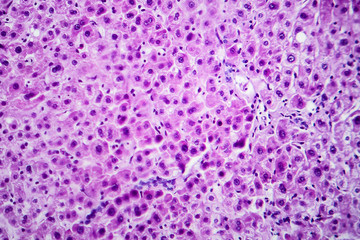 Cloudy swelling of the liver, light micrograph, photo under microscope