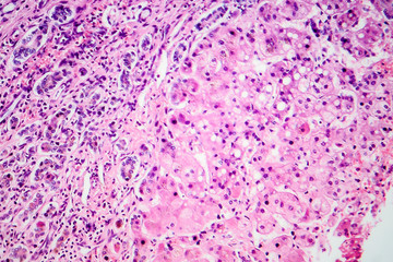 Small nodular cirrhosis, light micrograph, photo under microscope