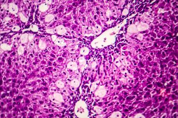 Histopathology of acute hepatitis, light micrograph, photo under microscope