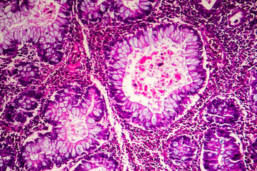 Villous colon adenocarcinoma, light micrograph, photo under microscope