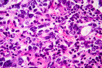 Gastric adenocarcinoma, light micrograph, photo under microscope. High magnification