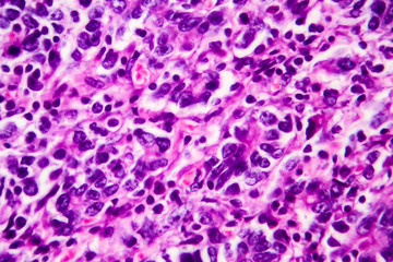 Gastric adenocarcinoma, light micrograph, photo under microscope. High magnification
