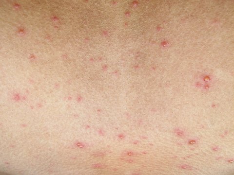 Human skin with chicken pox disease, varicella virus on young boy body, bubble rash texture