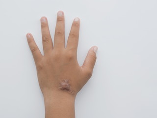 Hypertrophic scar (Keloid scar) on left hand back of young Asian woman on white background,...