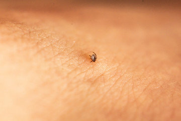 Tick with its chelicerae sticking in human skin.