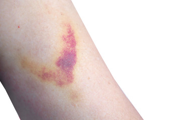 Fototapeta premium large injection bruised on woman arm closeup 