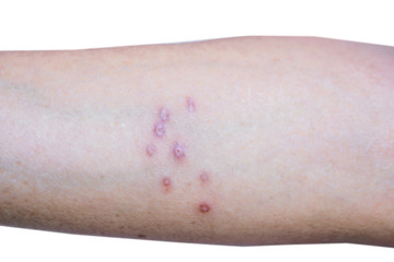 scar from skin infected Herpes zoster virus on woman arm