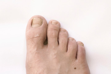 Il termine micosi indica la condizione in cui dei funghi patogeni superano la resistenza delle barriere del corpo umano o degli animali provocando infezioni.