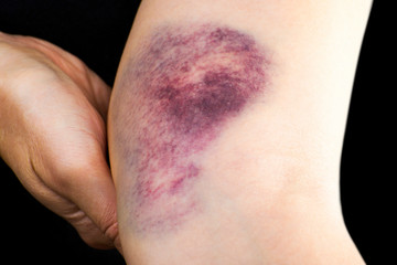 Close up of a hematoma on woman arm near elbow.