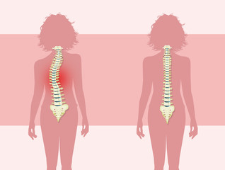 woman with scoliosis problem