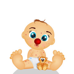 child with chicken pox with clown nose therapy