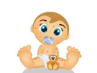 baby with measles