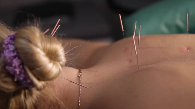 Needles on a woman's back.Dry needling.Trigger point therapy.Dry needling.Traditional Chinese medicine.Acupuncture