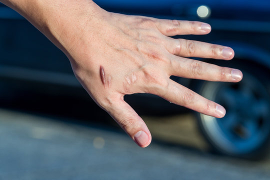 Keloid scar (Hypertrophic Scar) on man hand skin after accident. keloidal scar on wrist skin cause by surgery in car accidental , is a formation of a type of scar at the site of a healed skin injury.