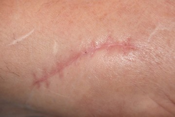 Operationsnarbe an der Hand 