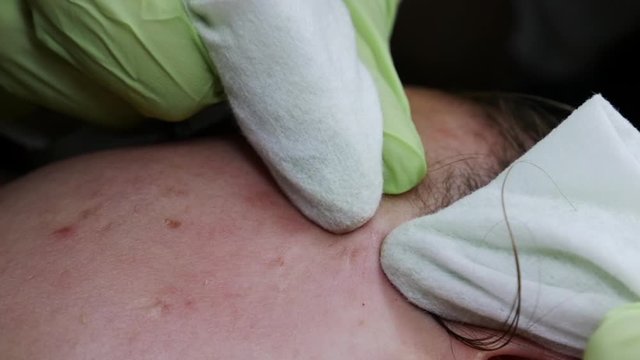 Beautician squeezing pimple blackheads for young wonan in beauty salon.