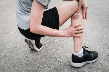 Shot of sport woman suffering from injury, she had bruise on her leg. Injured after runner falling or impact floor. Bruises happen when small blood vessels in the skin are damaged.