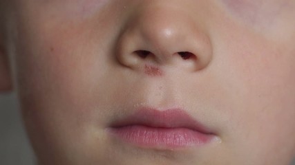 Close-up face of a little boy with a scratched nose. The child fell and scratched the skin under the nose. A wound on the face of a little boy. 4K
