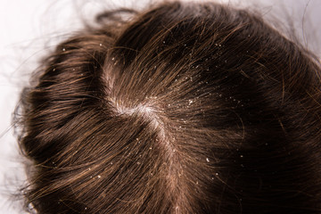Dandruff seborrhea problem of scalp and hair treatment of peeling from allergies or lichen. - obrazy, fototapety, plakaty
