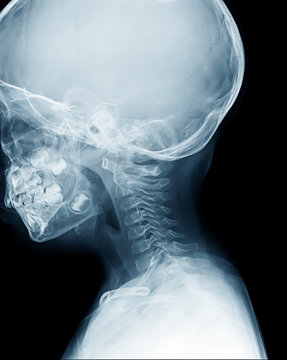 X-ray of neck and cervical side view, MRI neck x-ray
