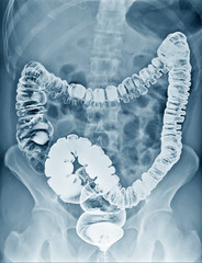 Film x-ray acute abdomen Chest AP,Abdomen view