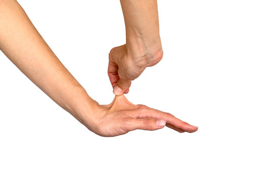 marfan syndrome hands