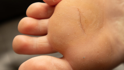 Close-up of callused and cracked skin female foot