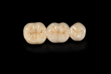 Ceramic tooth crowns and metal pins close-up macro. Orthopedic dentistry restoration of decayed teeth
