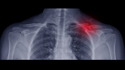 Film X-ray shoulder radiograph show Left collar bone broken (clavicle fracture) from traffic accident. Highlight on fracture bone site and painful area. Medical insurance and imaging concept. 