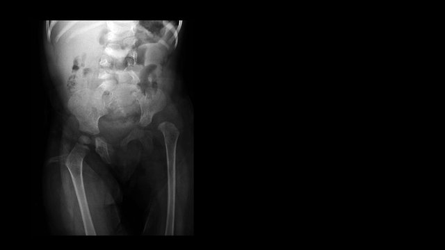 Film X Ray Hip Radiograph Show Congenital Developmental Dysplasia Of Left Hip(DDH) Disease With Hip Joint Subluxation. The Patient Has Hip Pain, Limping And Walking Problem. Medical Technology Concept