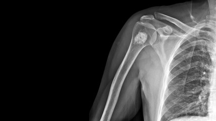 Film X ray shoulder radiograph show Enchondroma disease at arm bone. Enchondrama is a benign tumor of cartilage grow within bone and expand it. Medical oncology and investigation concept - obrazy, fototapety, plakaty