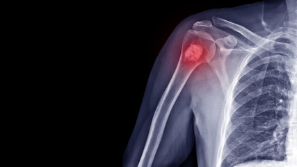 Film X-ray shoulder radiograph show Enchondroma disease at arm bone. Enchondrama is a benign tumor...