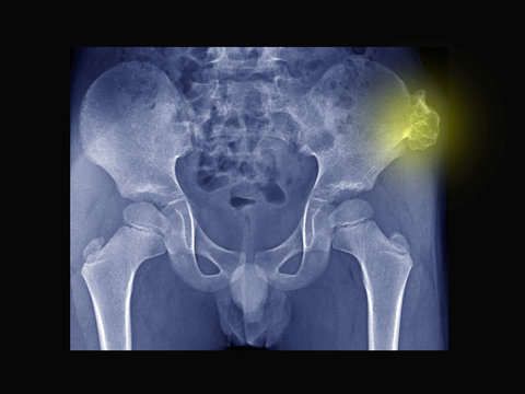 Film X ray pelvis radiograph show Osteochondroma disease at left pelvic bone. Osteochondrama is the most common benign tumor of bone. Highlight on bone mass. Medical imaging concept