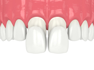 3d render of upper jaw with veneers