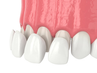 3d render of upper jaw with four veneers © Aleksandra Gigowska